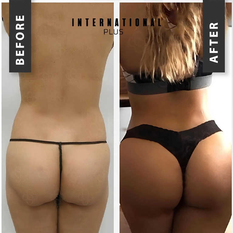 BBL Price Istanbul 2025