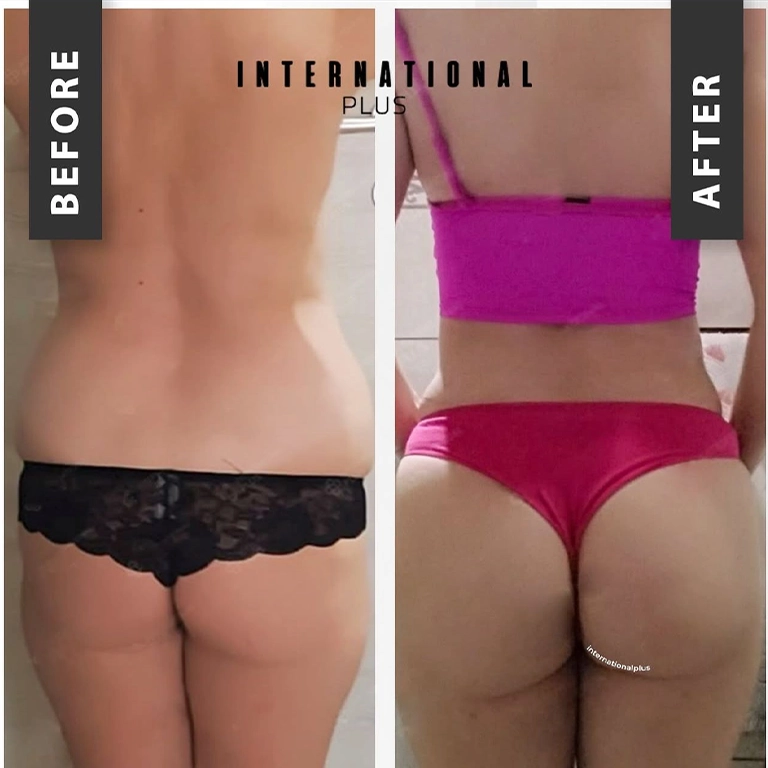 BBL and 360 Lipo Cost Turkey