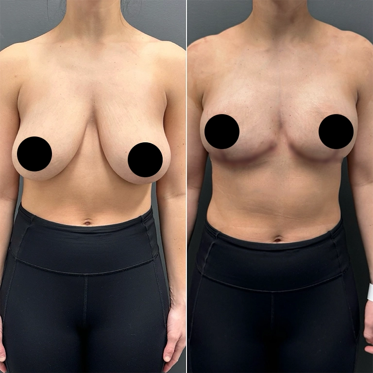 Back Pain and Large Breasts