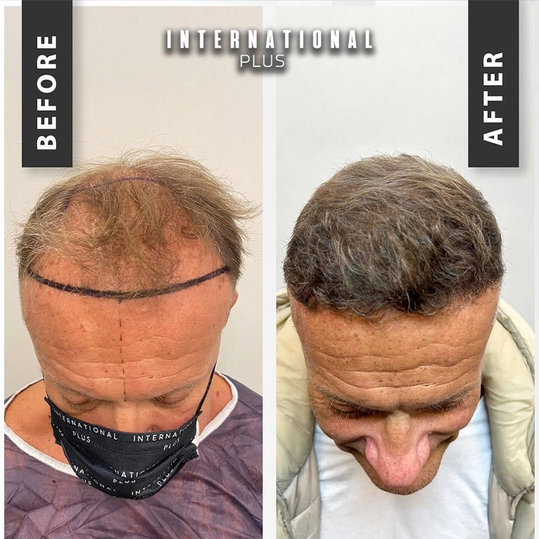 Best Candidates For Unshaven FUE