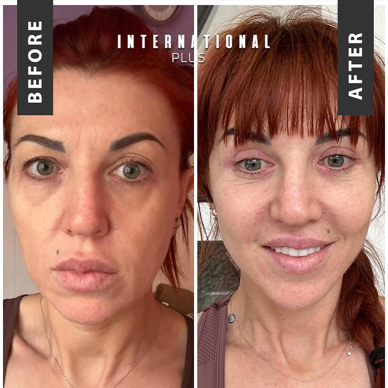 Best Facelift Surgeon Turkey