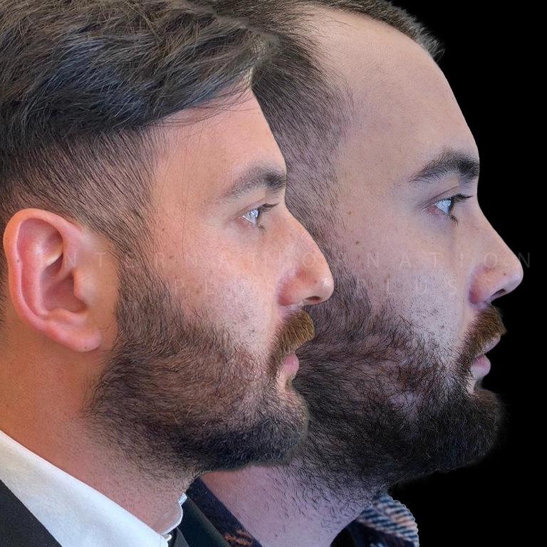 Best Rhinoplasty Surgeon Turkey