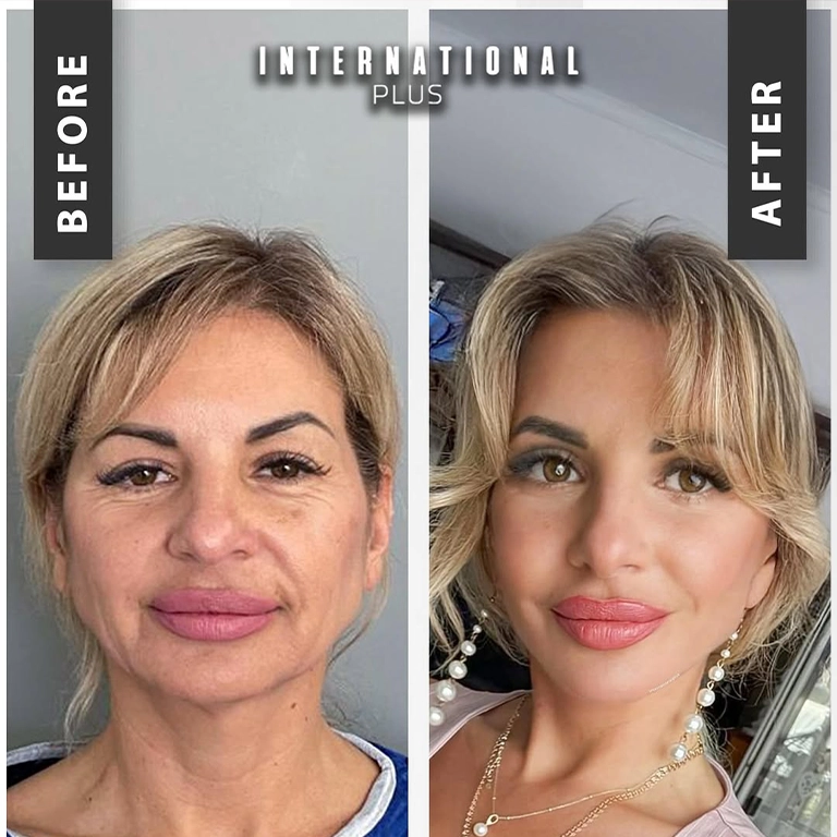 Blepharoplasty Scars