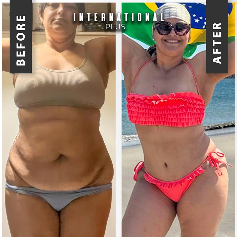 Body Lift Scars Management