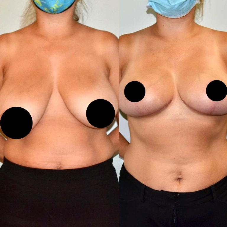 Breast Reduction Scars