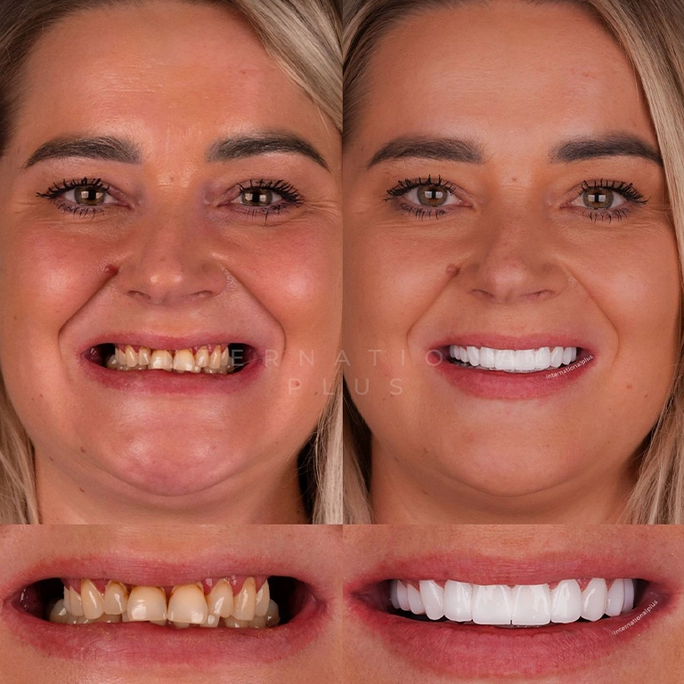 Cost Comparison UK vs Turkey