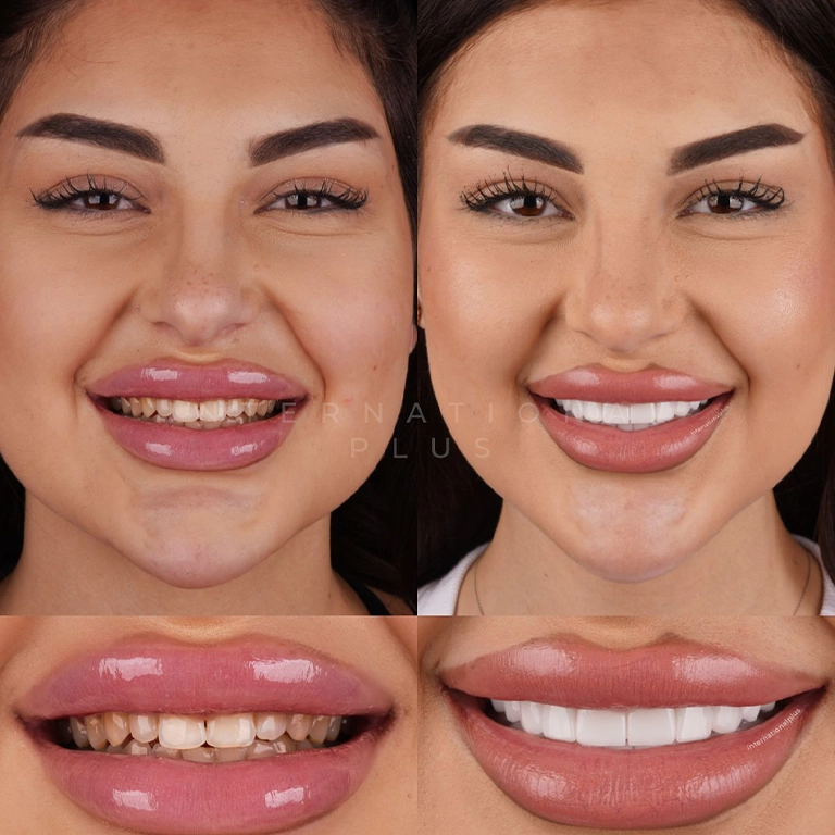 Crowns vs Veneers Durability