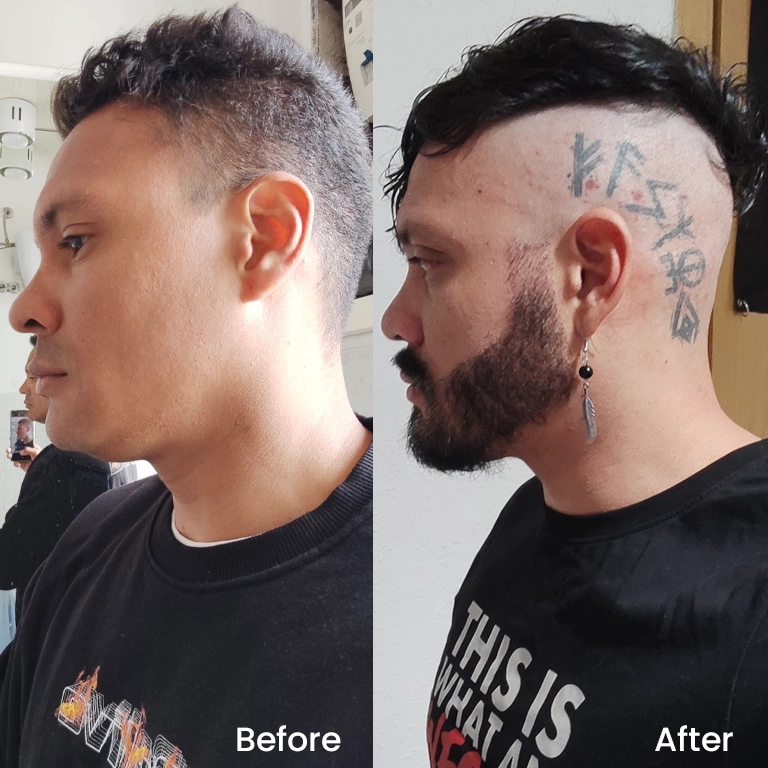 DHI Beard Transplant