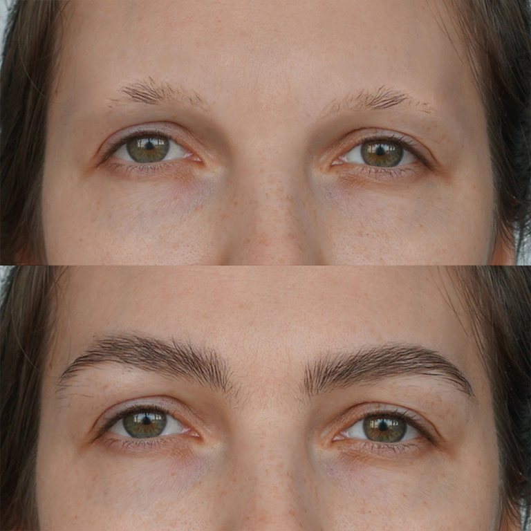 DHI Eyebrow Transplant