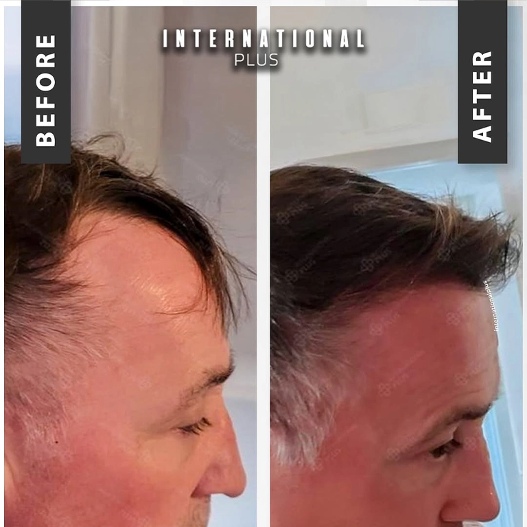 DHI Unshaven Transplant