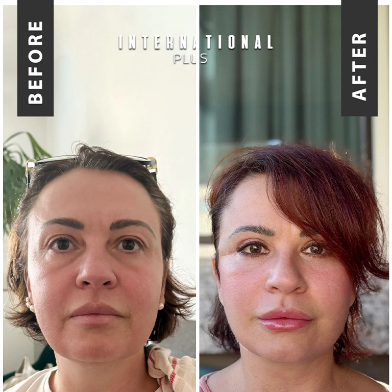 Deep Plane Facelift Before After