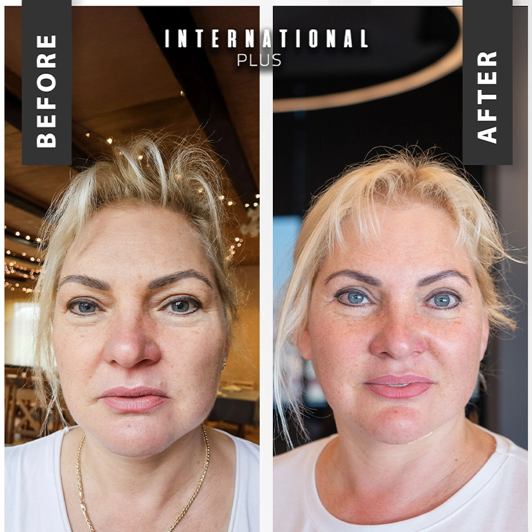 Deep Plane vs SMAS Facelift