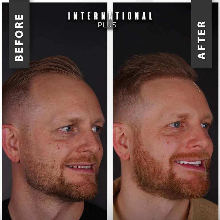 Density With Sapphire FUE