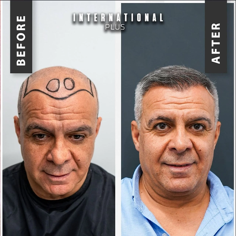 Difference Between DHI and FUE