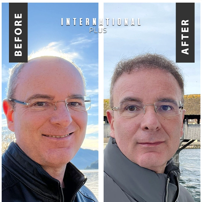 Donor Area After 10 Days