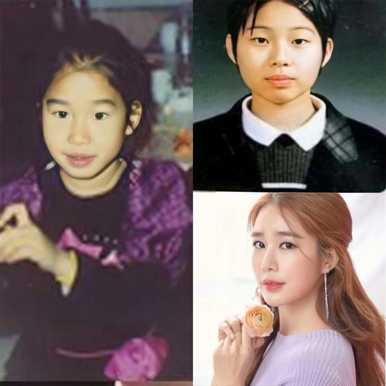 Double Eyelid Surgery Turkey