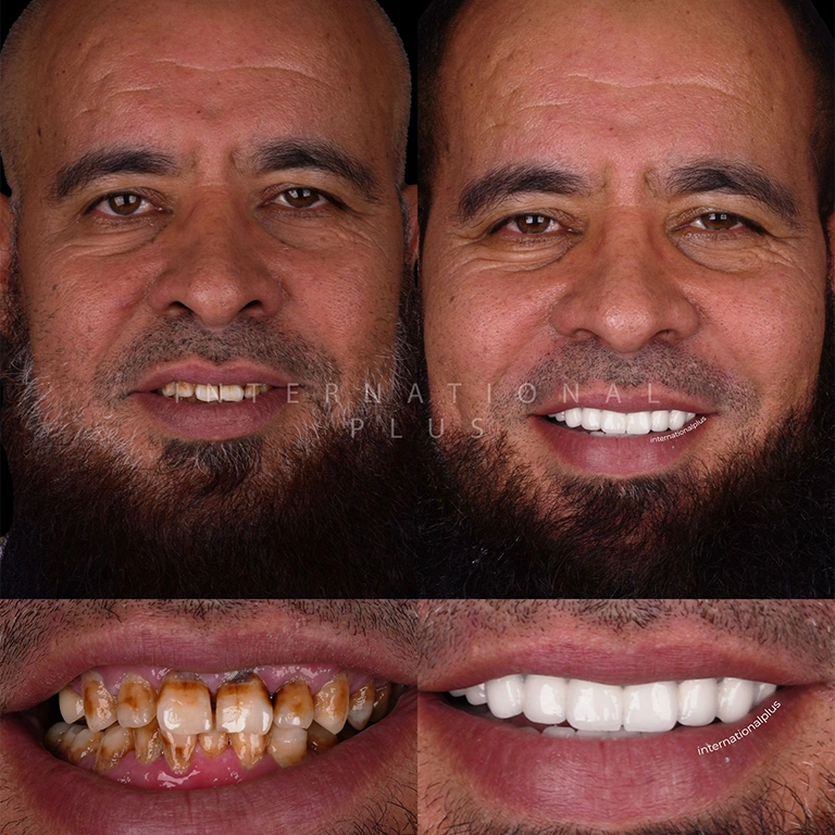 Durability Of Zirconium