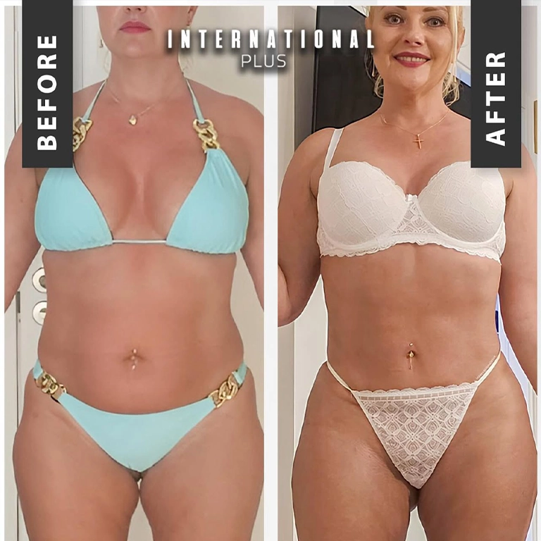 Full Tummy Tuck Scar