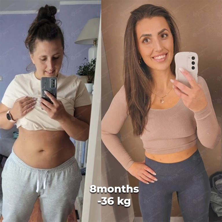 Gastric Botox Results