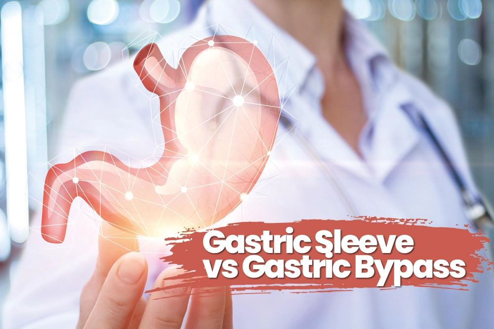 Gastric Sleeve vs Gastric Bypass