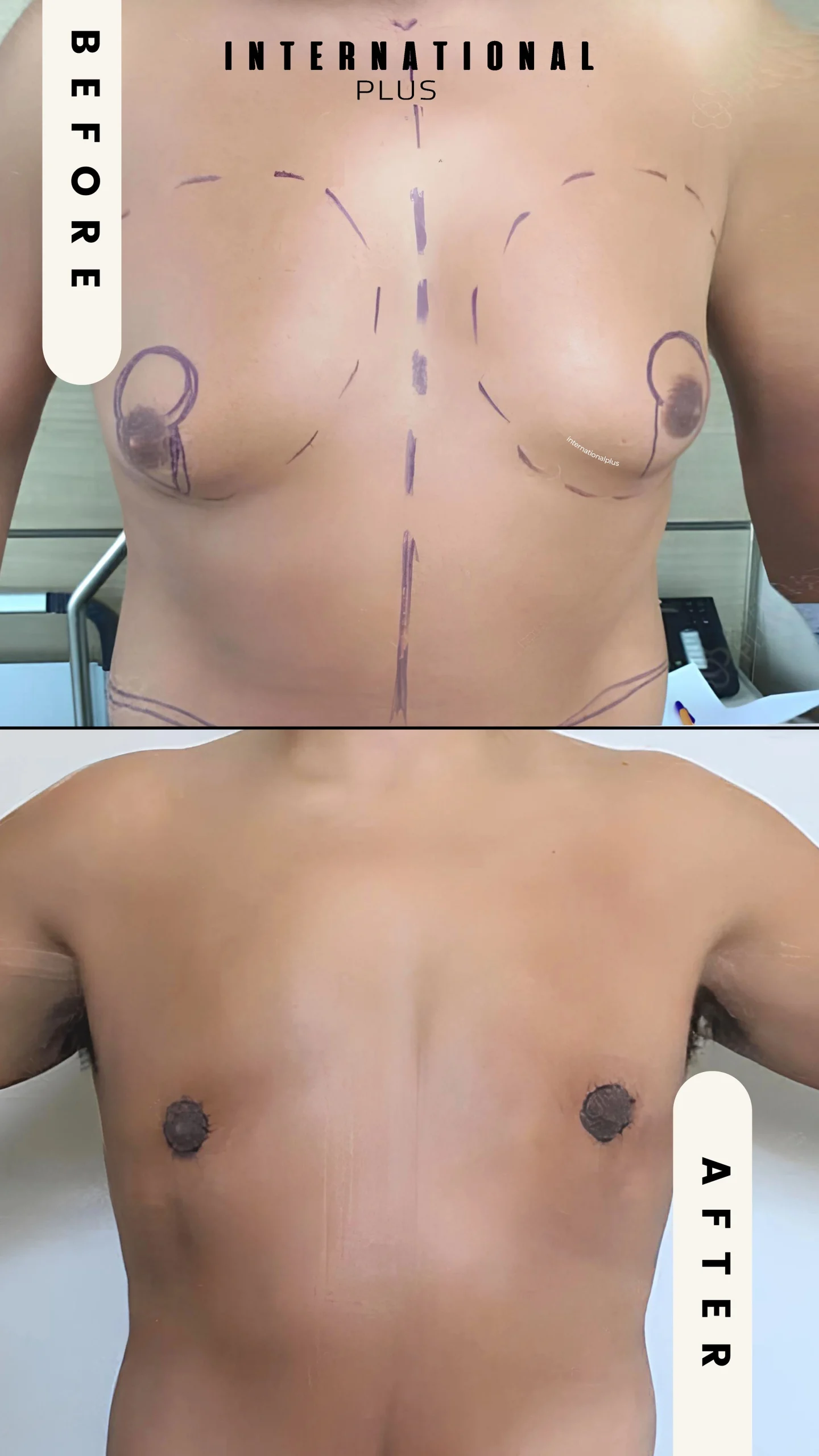 Gynecomastia Grades Explained