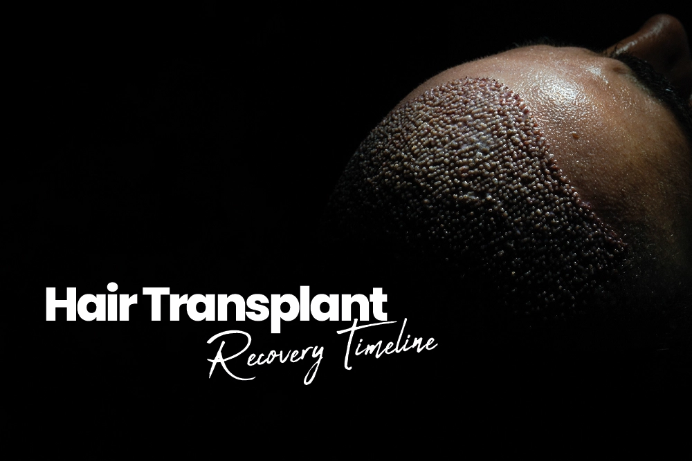 Hair Transplant Recovery Timeline