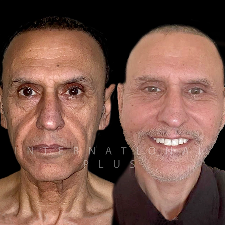 Hollywood Cheek Surgery