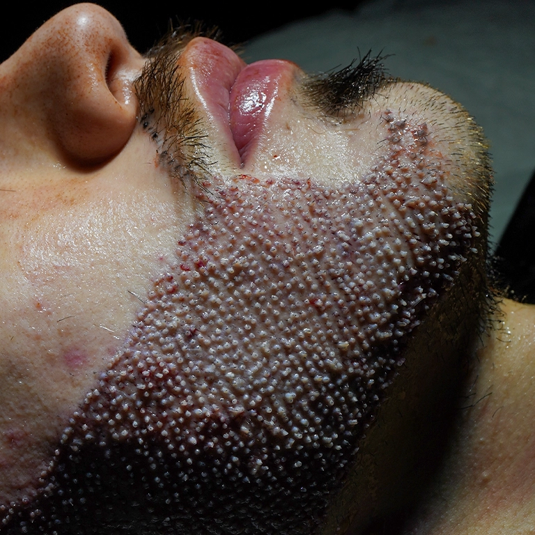 How Many Grafts For Beard