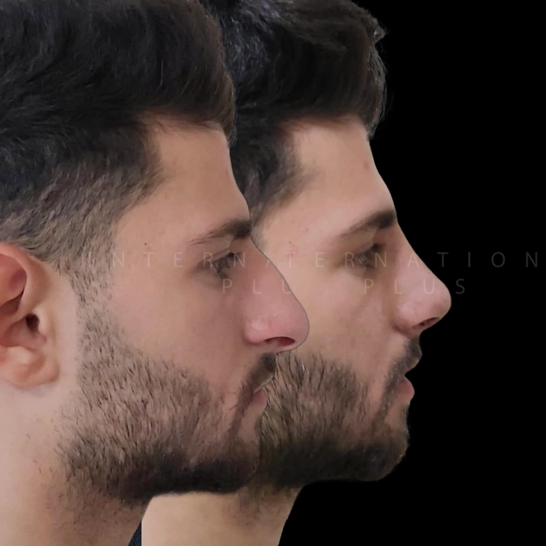 Is Piezo Rhinoplasty Safe