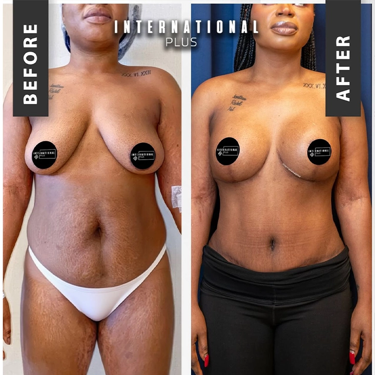 Laser Treatment For Scars