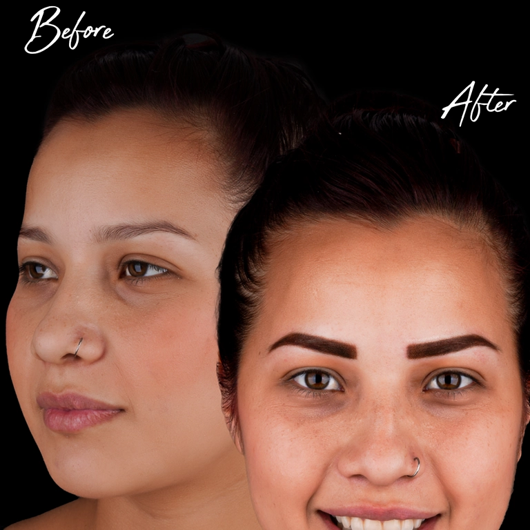 Microblading vs Transplant