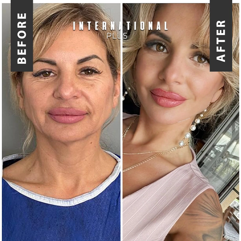 Neck Lift and Facelift