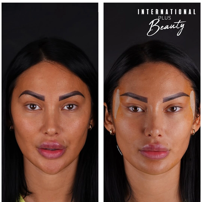 Non Surgical Fox Eye Lift