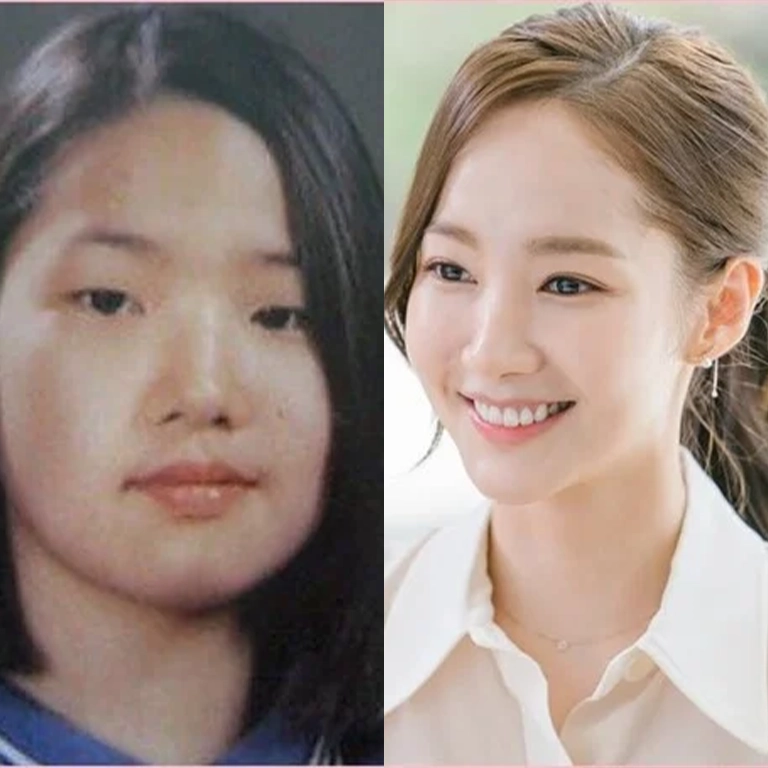 Park Min Young Nose Job