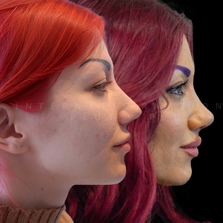 Piezo vs Traditional Rhinoplasty