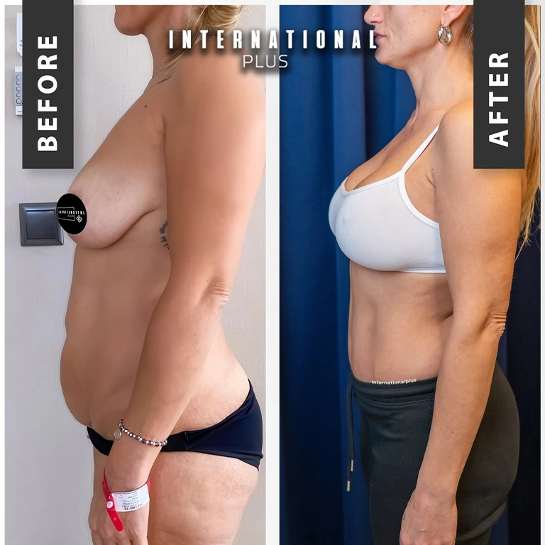 Post Bariatric Surgery Steps