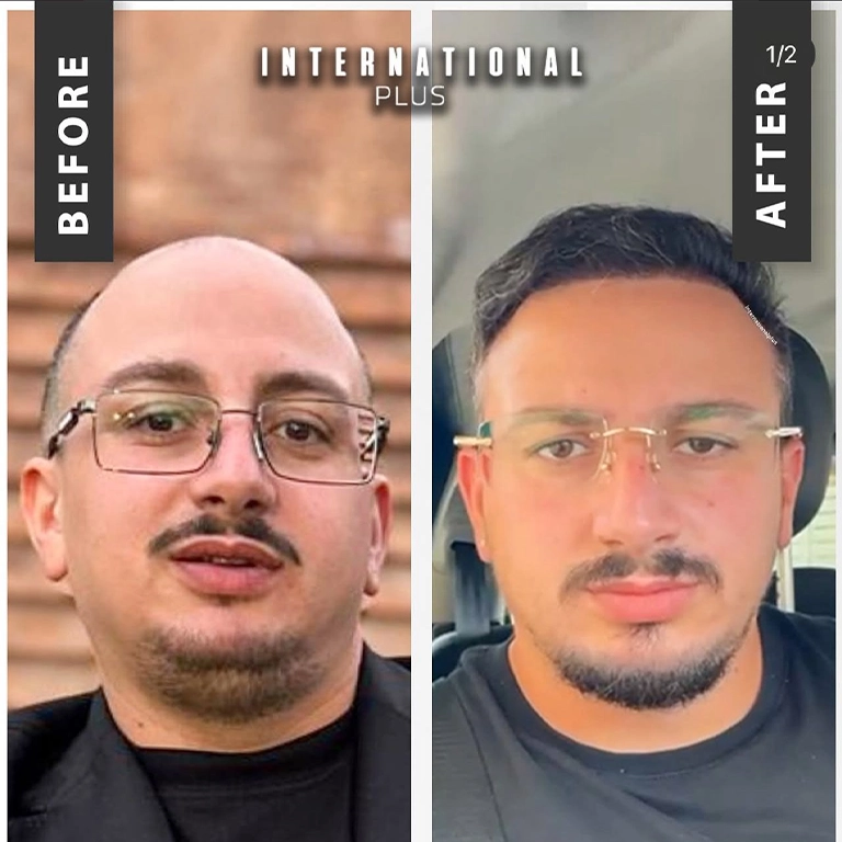 Recovery Time DHI vs FUE