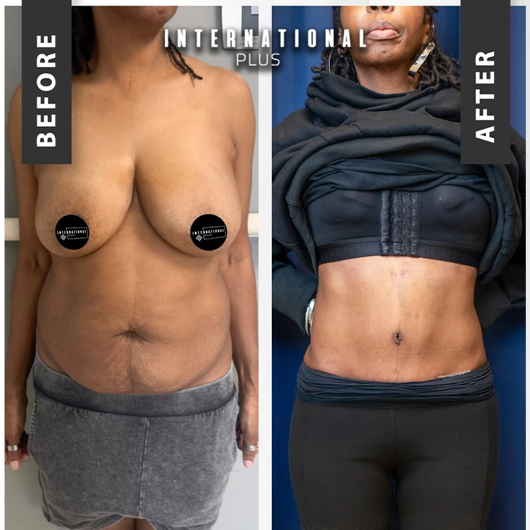 Removing Excess Skin