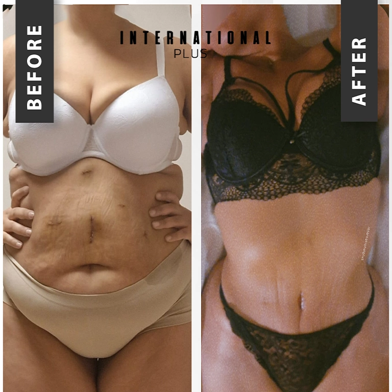 Scar Placement Tummy Tuck