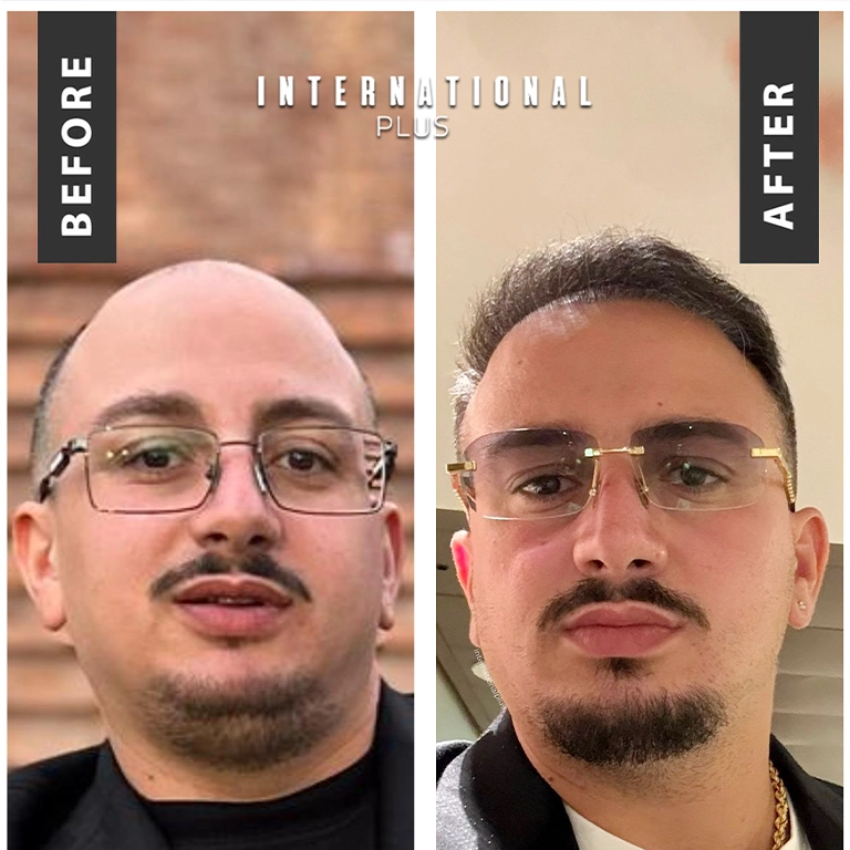 Shock Loss In Donor Area