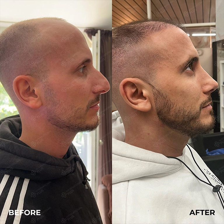 Thick Skin Revision Rhinoplasty