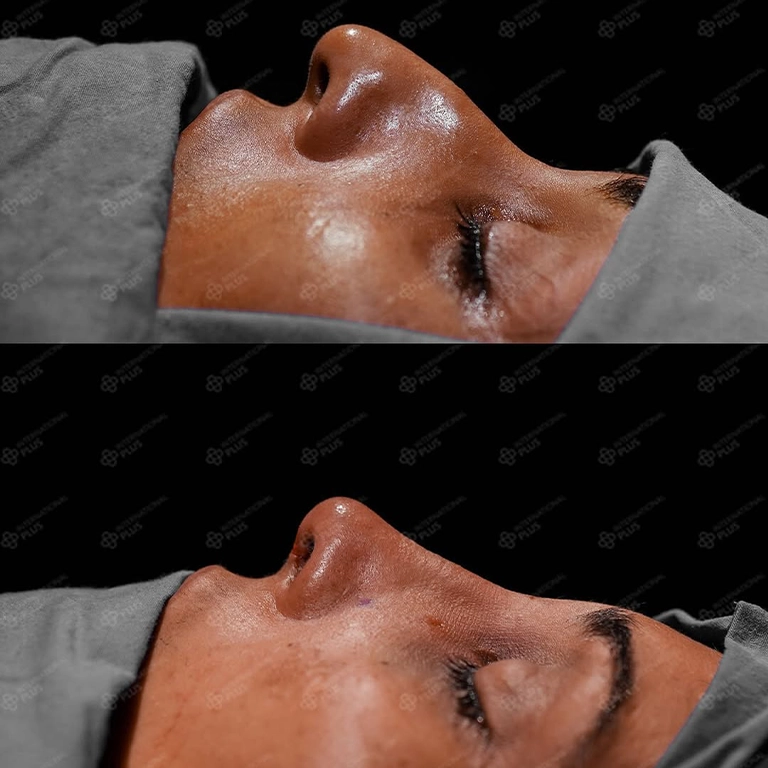 Thick Skin Rhinoplasty Techniques