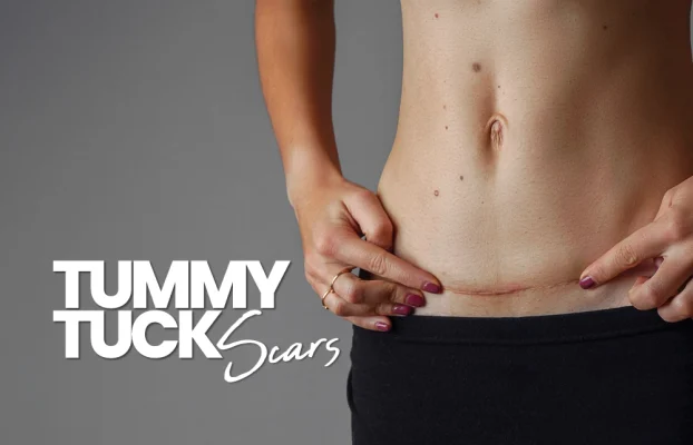 Tummy Tuck Scars