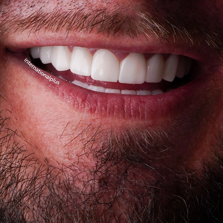 Turkey Teeth Packages Cost 2026