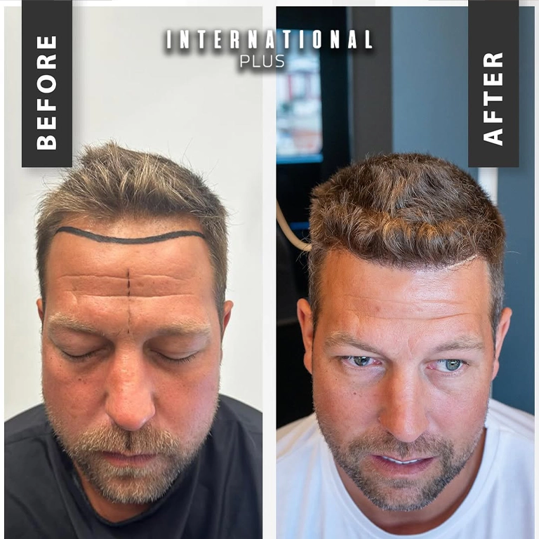 U-FUE Technique Explained