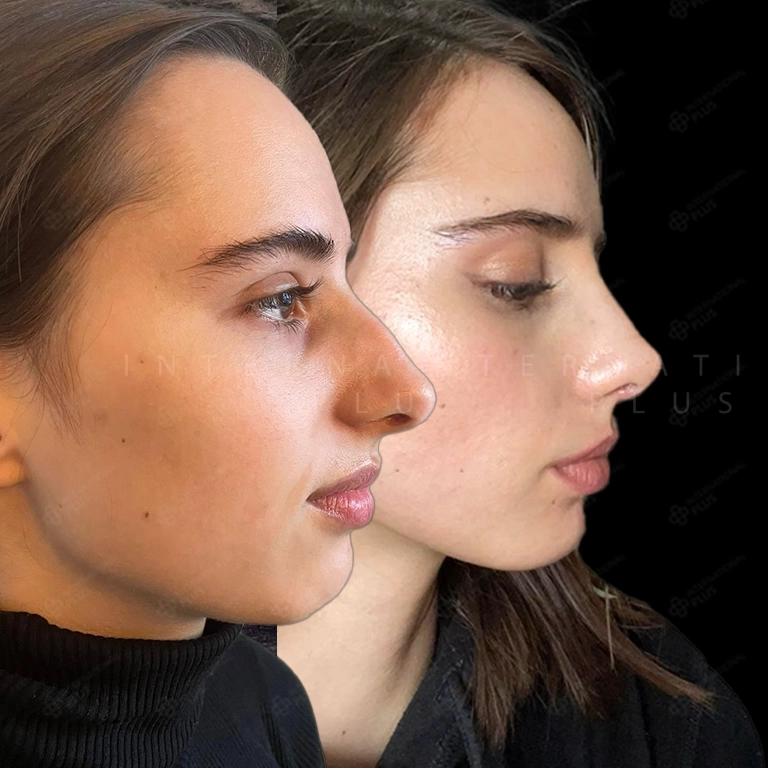 Ultrasonic Rhinoplasty Cost 2026