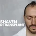 Unshaven Hair Transplant