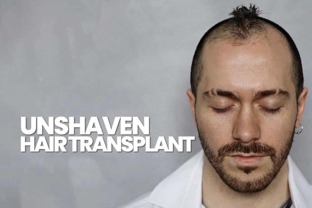 Unshaven Hair Transplant