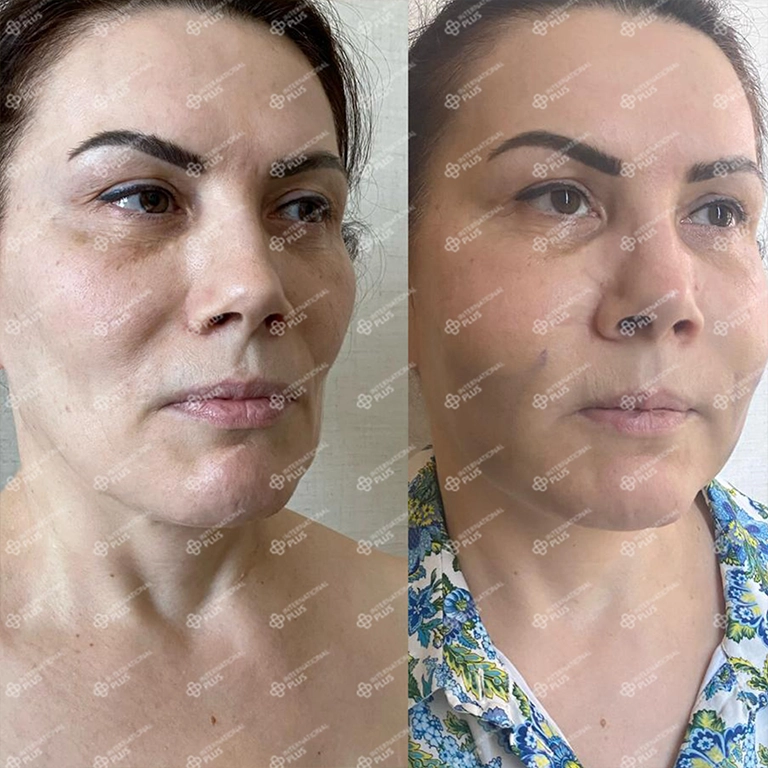 V-Shape Face Surgery