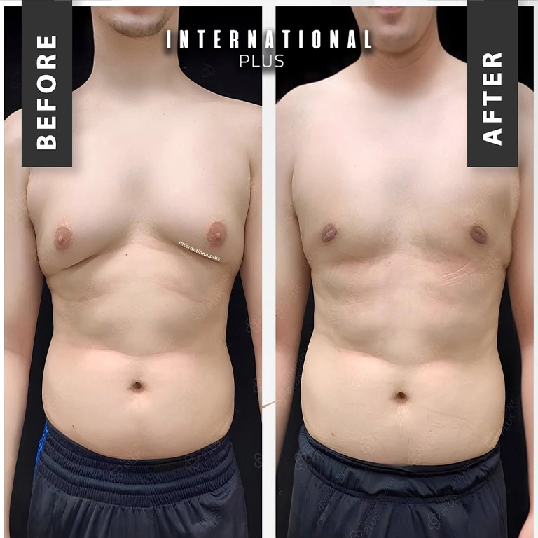 Vaser Lipo For Gynecomastia